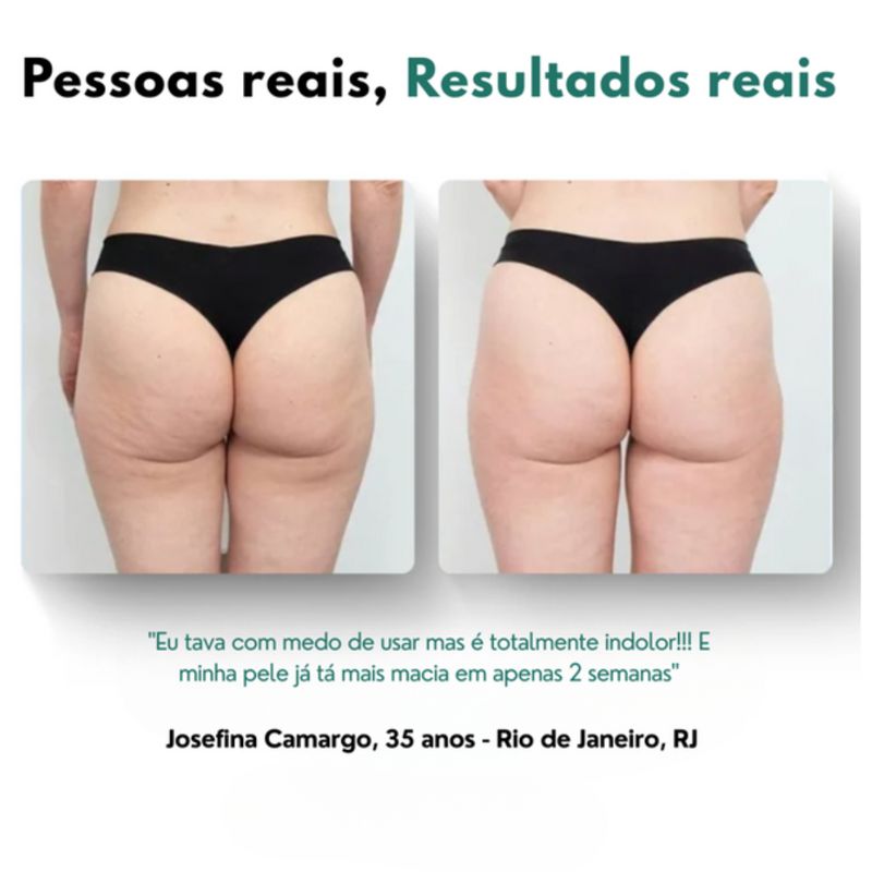 CelluWave® Massageador AntiCelulite + Brinde Exclusivo