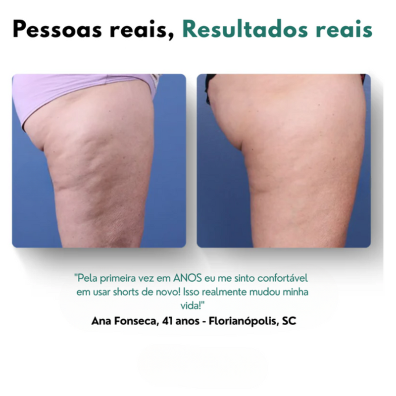 CelluWave® Massageador AntiCelulite + Brinde Exclusivo